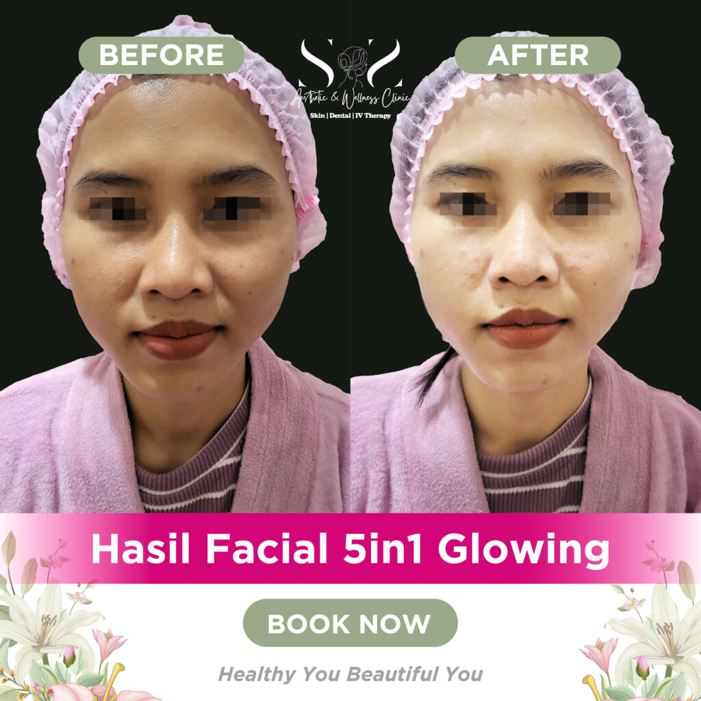 Before after SNS FAcial 5in1.ai 2