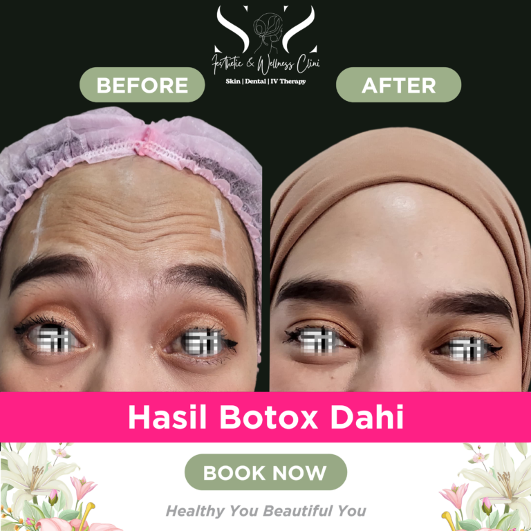 Botox dahi