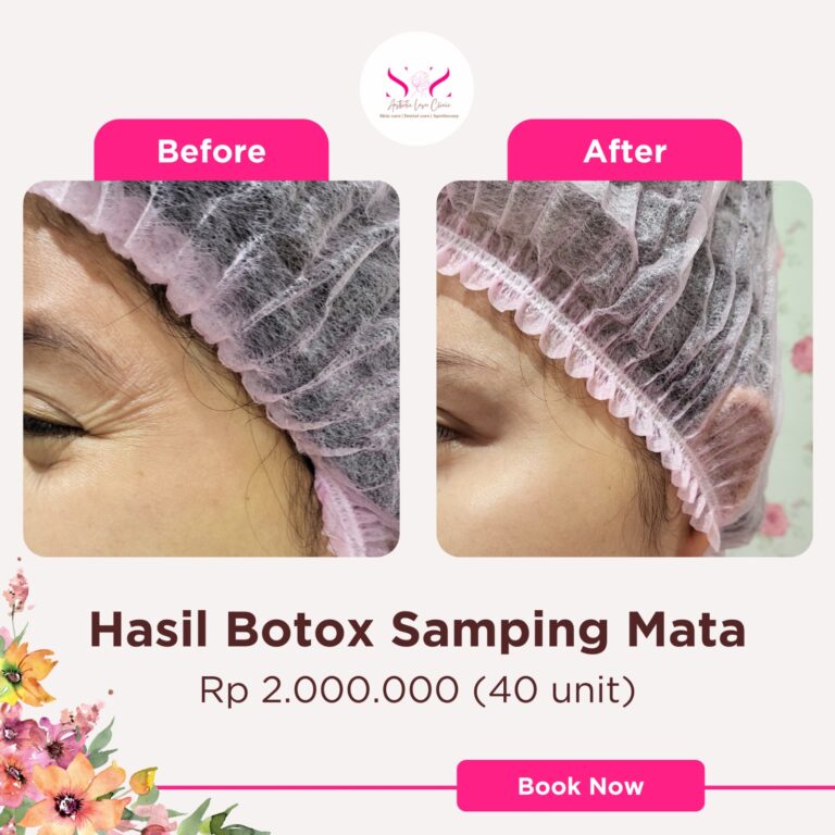 Botox samping mata