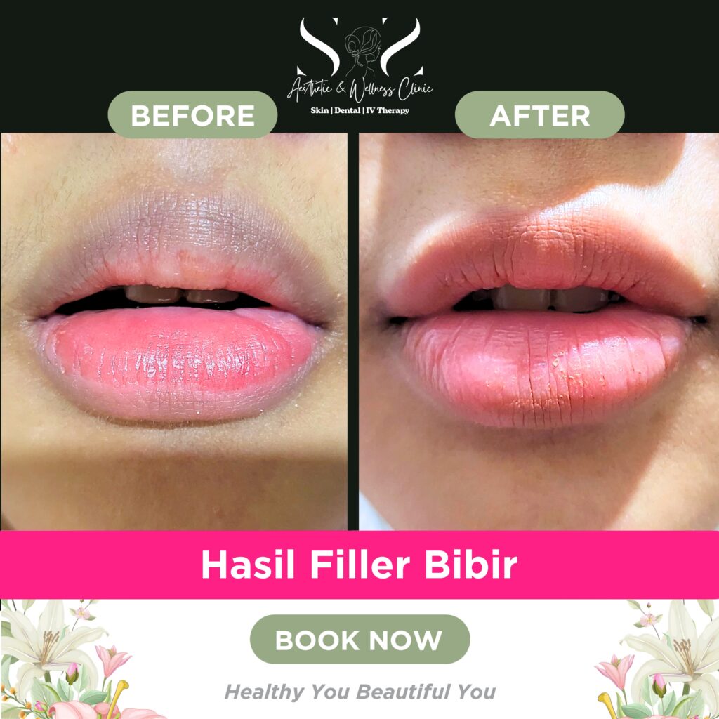 Melasme Treatment - 8