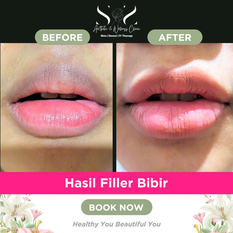 Melasme Treatment - 8