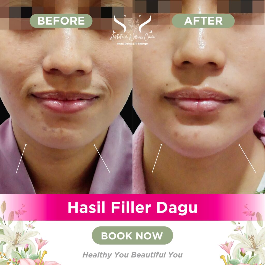 Filler dagu