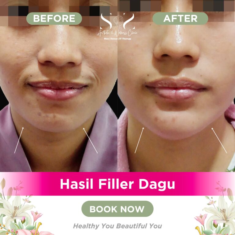 Filler dagu