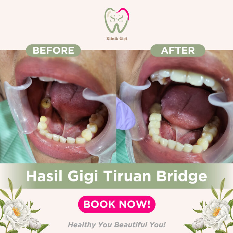 GIGI TIRUAN SNS KLINIK 3