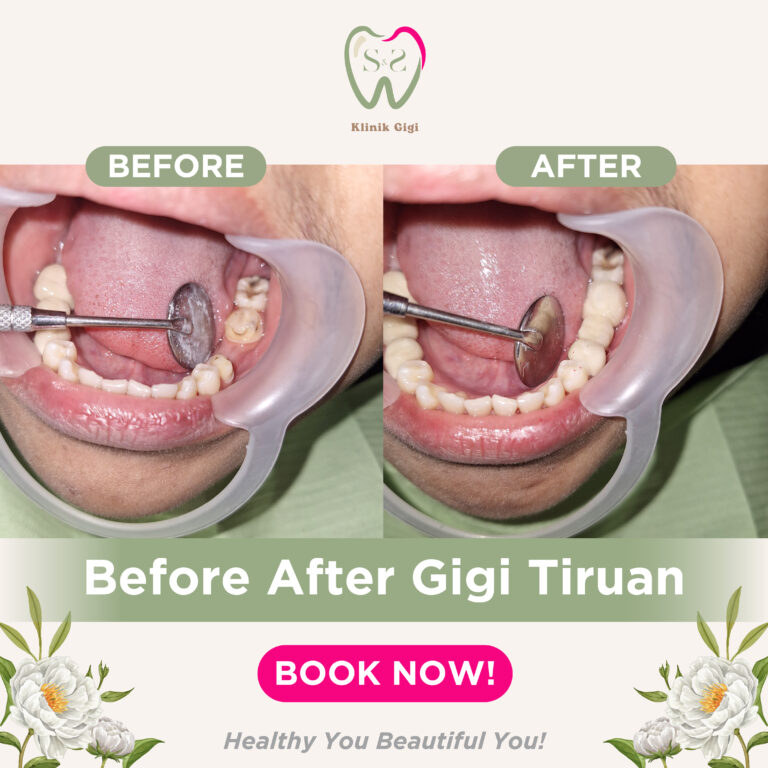 GIGI TIRUAN SNS KLINIK 2