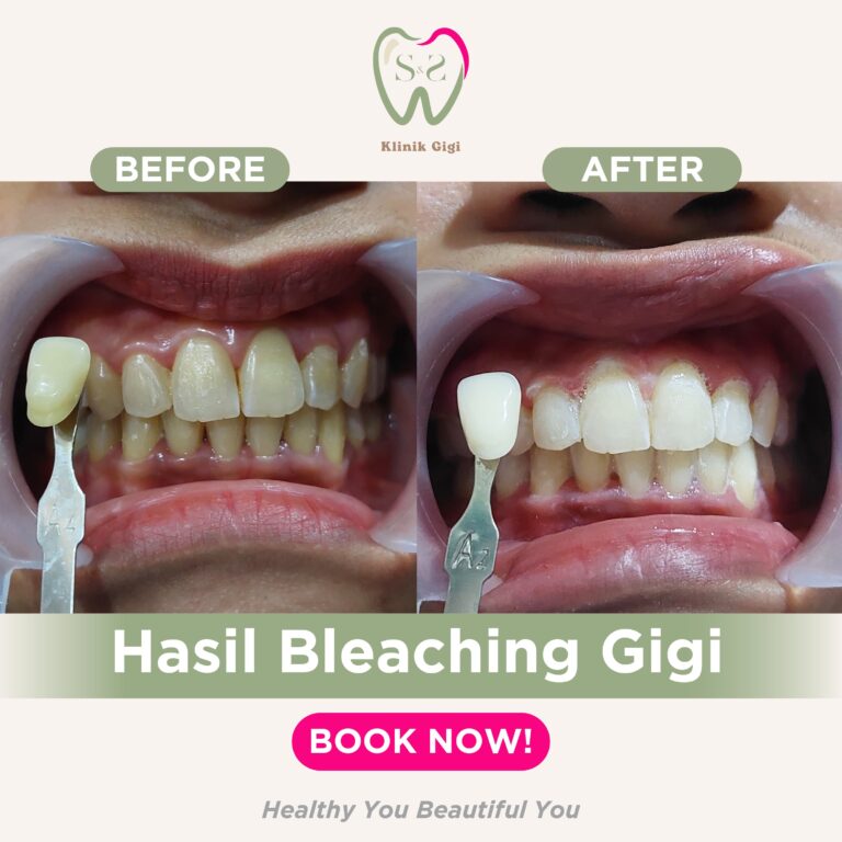 HASIL BLEACHING GIGI