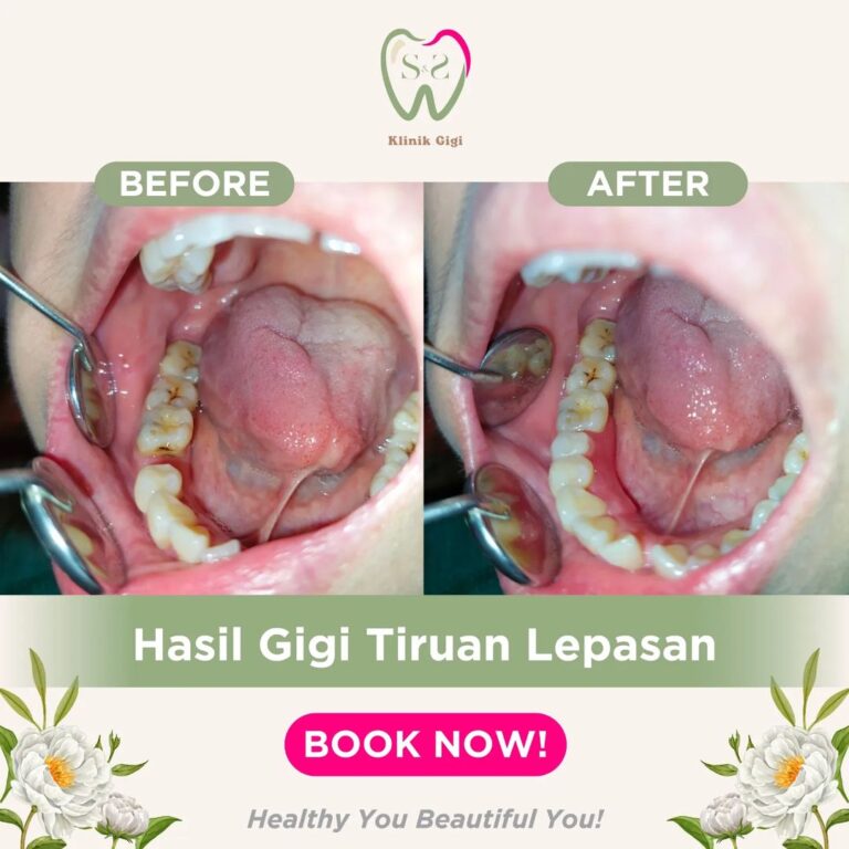 GIGI TIRUAN SNS KLINIK 1