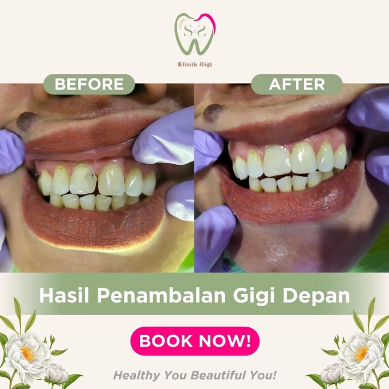 Tambal Gigi Depan SNS Klinik
