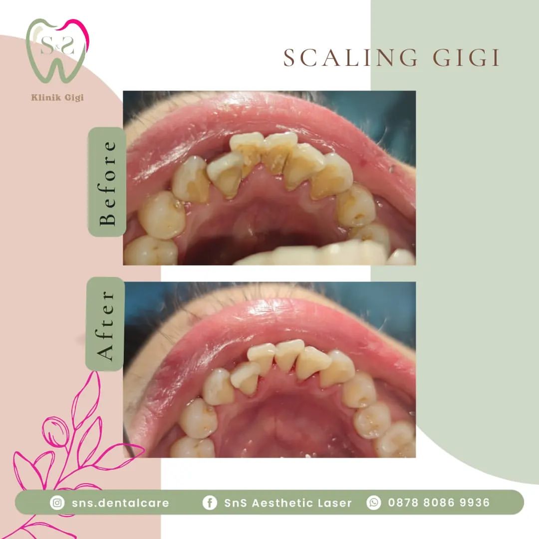 Scalling SNS Klinik 2