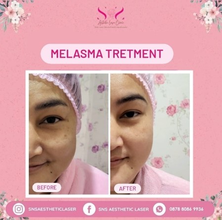 Melasma