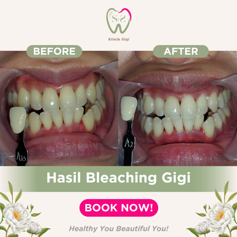 HASIL BLEACHING GIGI