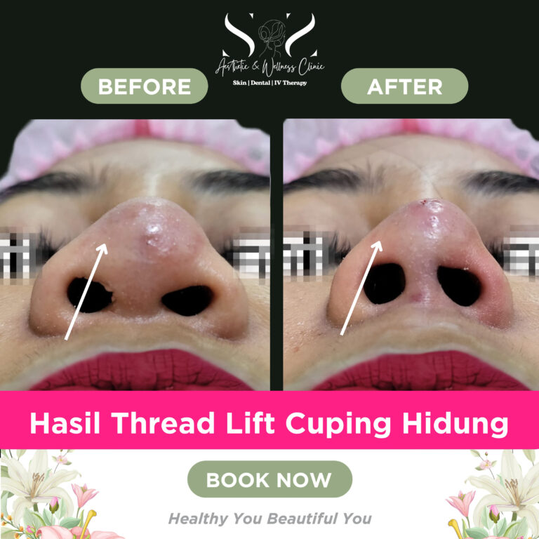 SNS hidung
