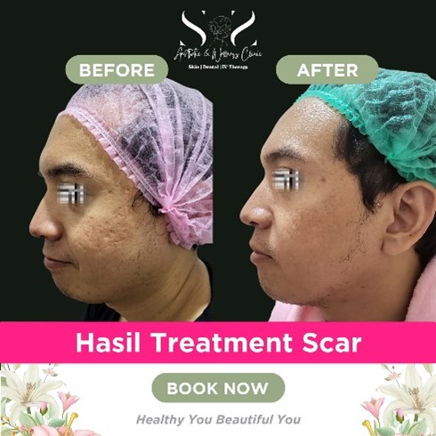 Scar Treatment