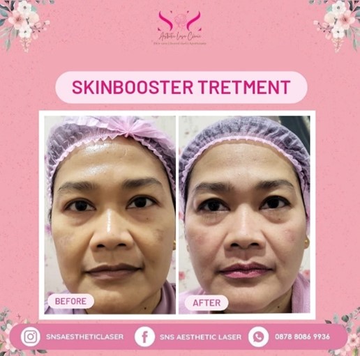 Skin Booster