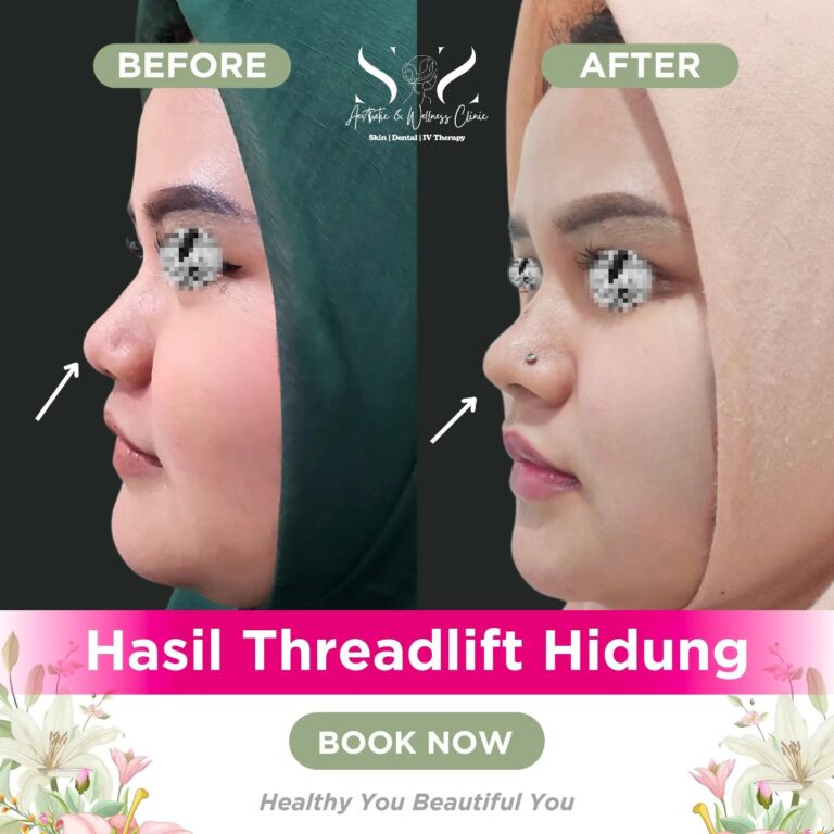 Threadlift hodung