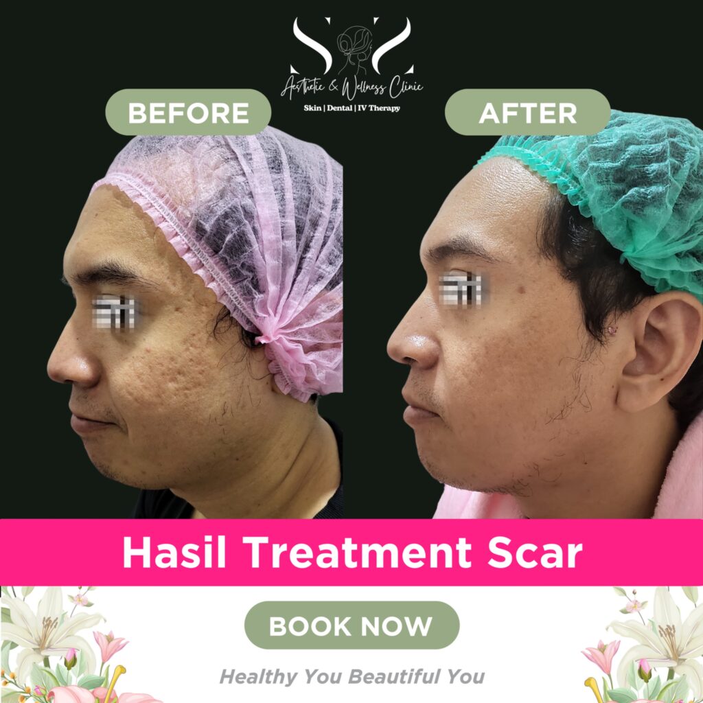 Treatment scar