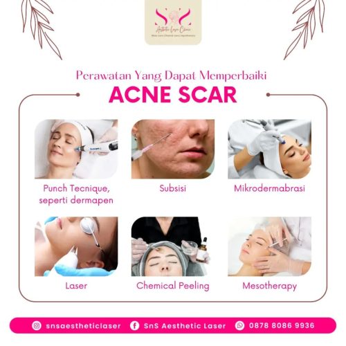 SNS Klinik Acne Scar