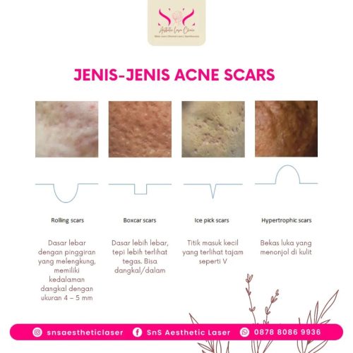 SNS Klinik Acne Scar