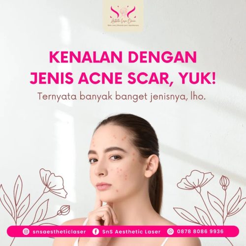SNS Klinik Acne Scar