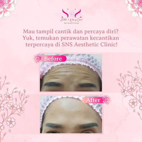 SNS Klinik Botox